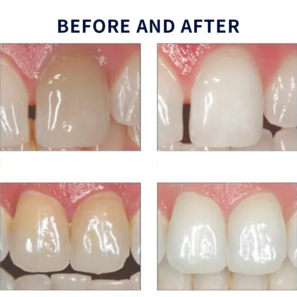 Opalescence Whitening 20% PF 2 - Teeth Whitening Gels Used By Dentists recension och pris
