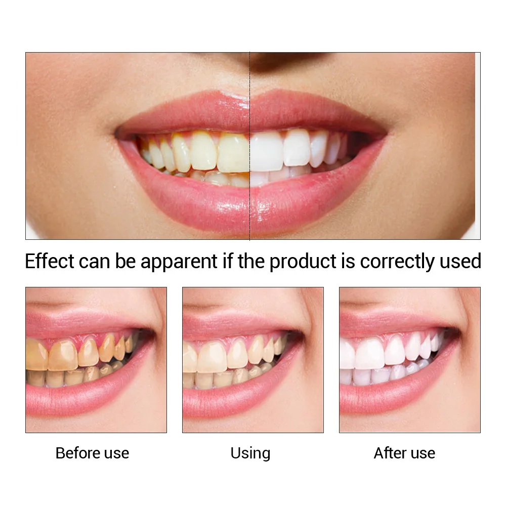 FTEENPLY Teeth Whitening Essen - Teeth Whitening From Home recension och pris