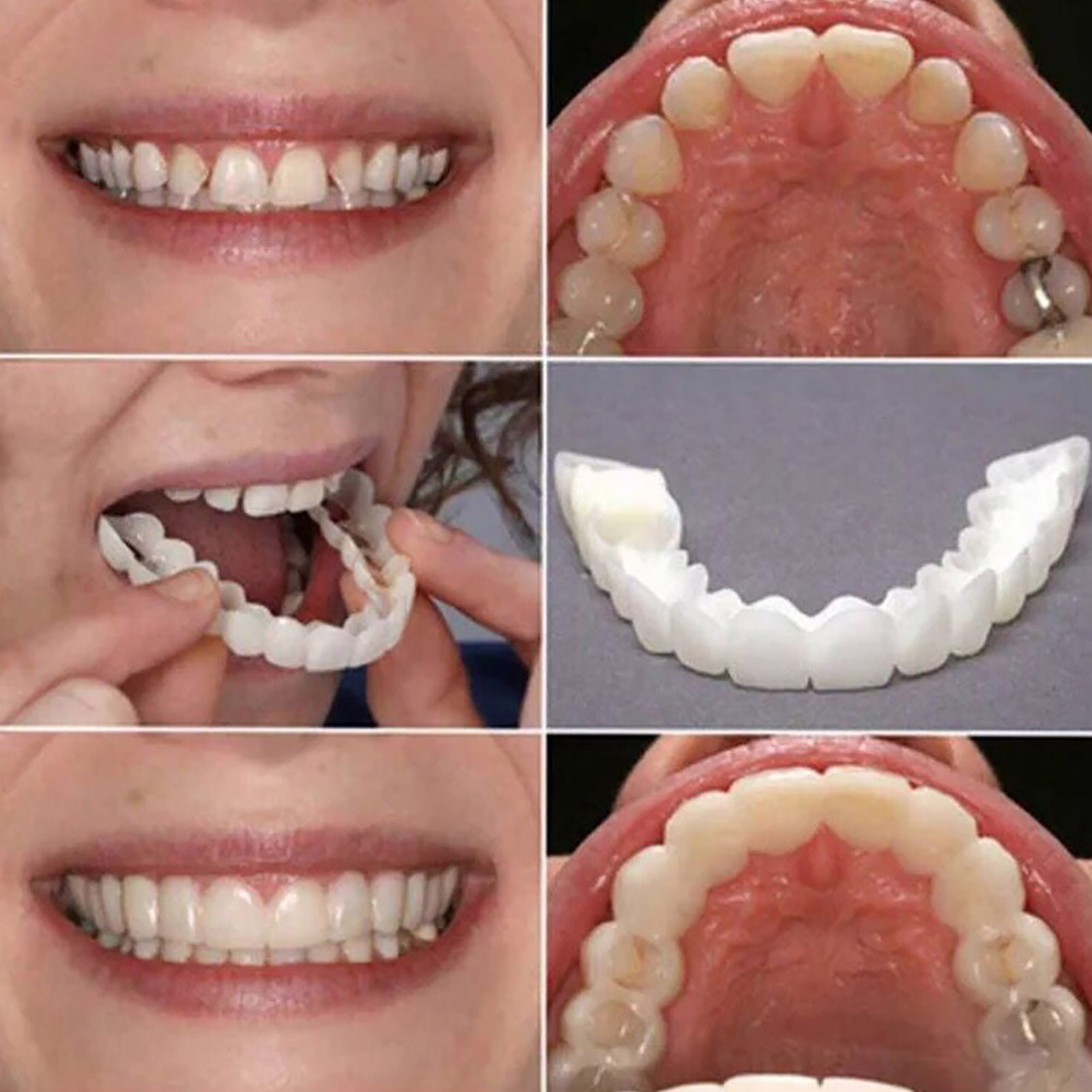 Hot Teeth Veneers Whitening De - Teeth Whitening With Braces recension och pris